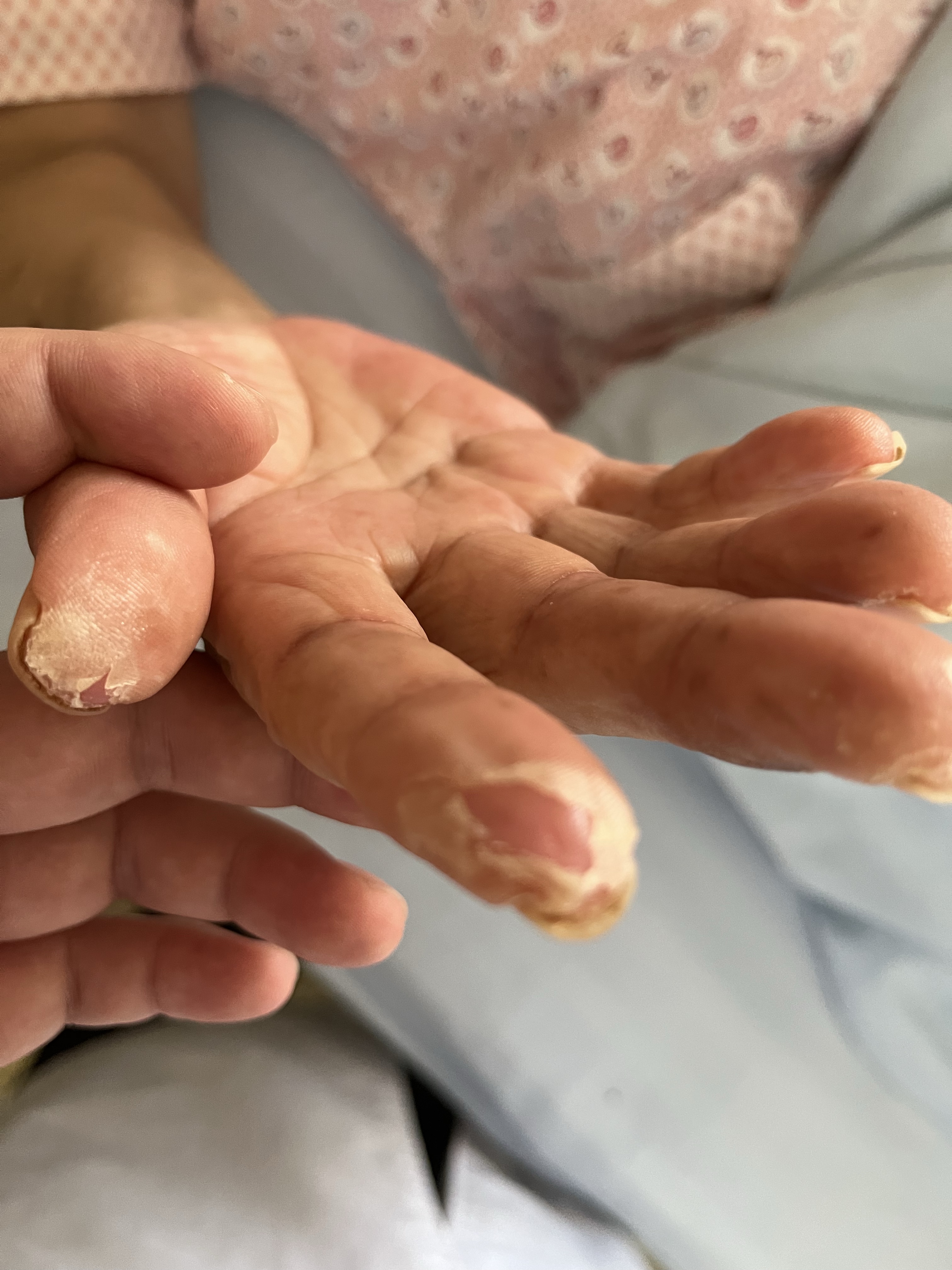 卡培他滨致手足综合症-老苏