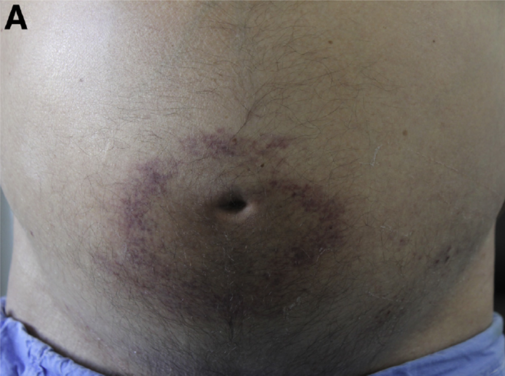 图片[1]-Cullen（卡伦）征是什么-老苏