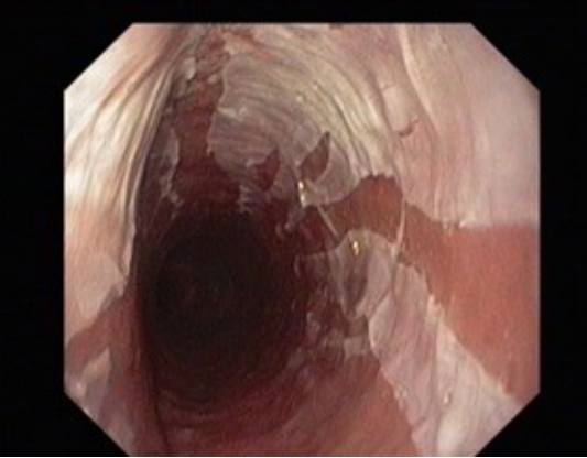 表皮剥脱性食管炎