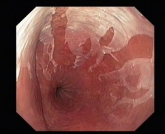 表皮剥脱性食管炎