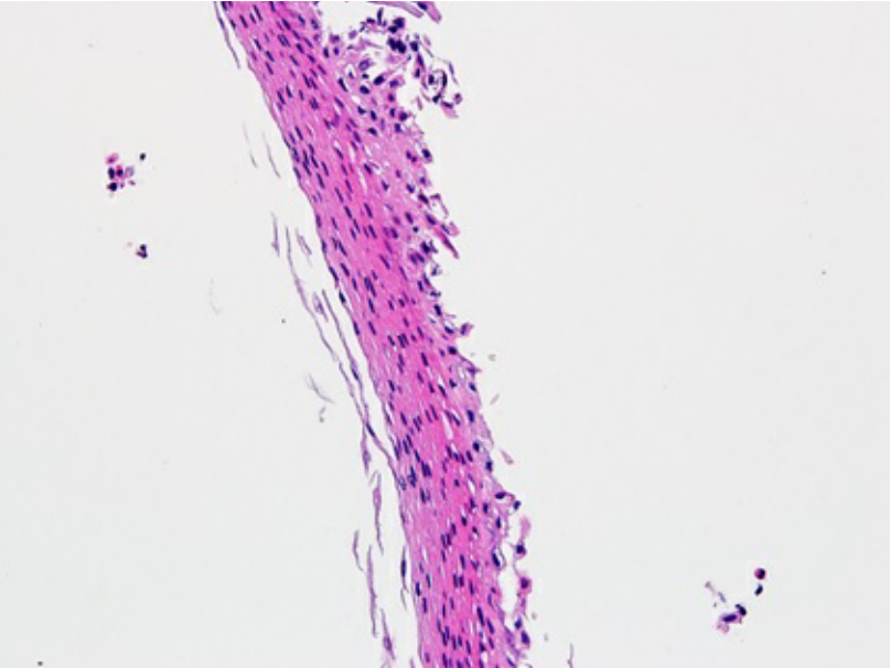 表皮剥脱性食管炎