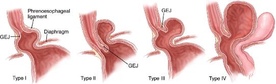 什么是食管裂孔疝-老苏