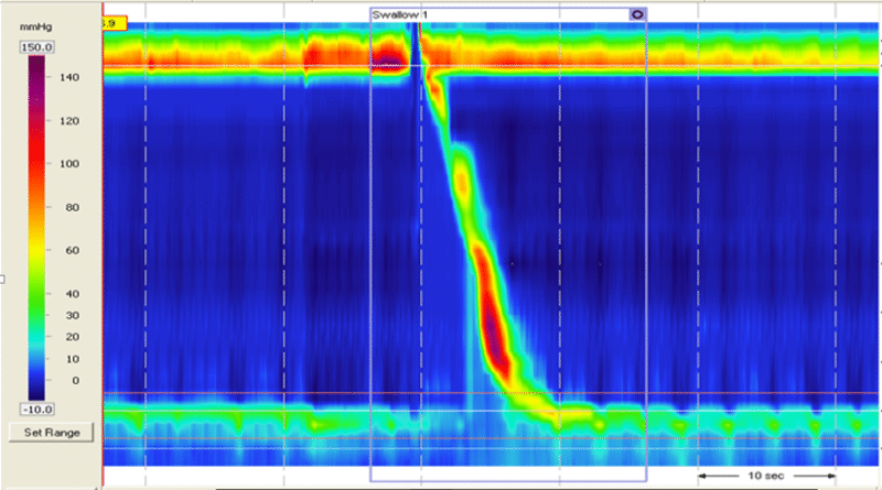高分辨率食管测压怎么做-老苏