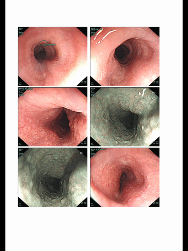 贲门失弛缓一例-老苏
