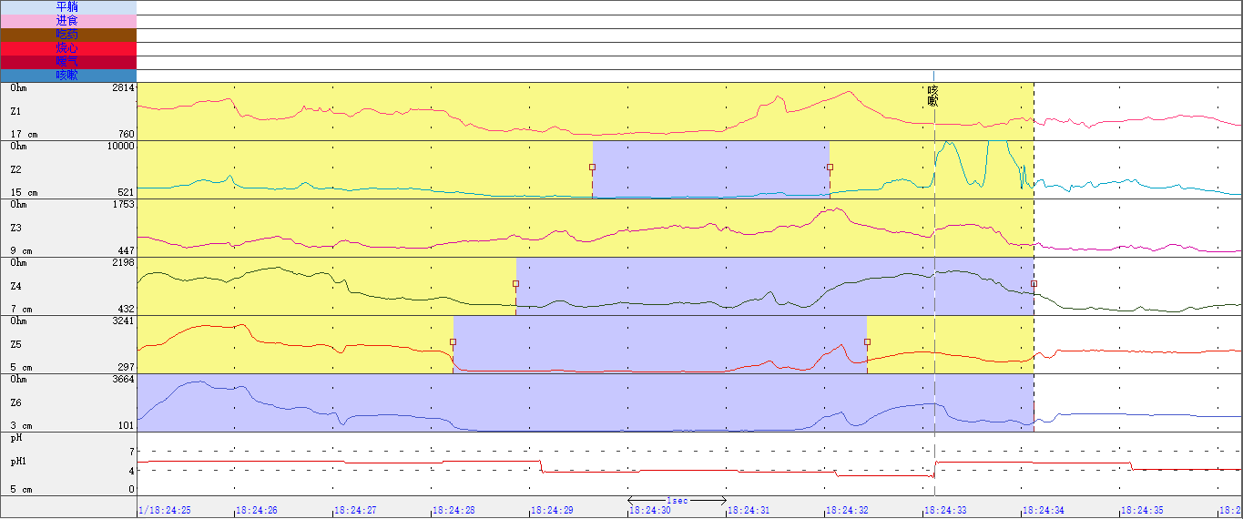 食道阻抗-ph联合监测之气体反流