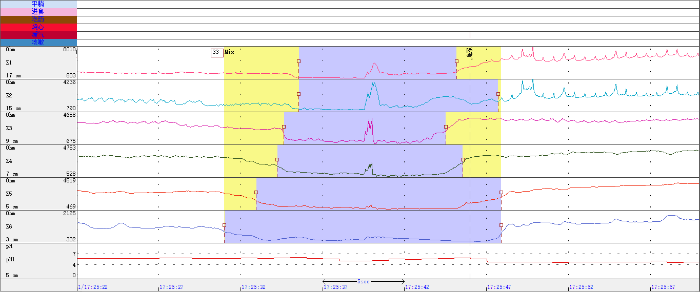 食道阻抗-ph联合监测之反流致咳嗽-老苏