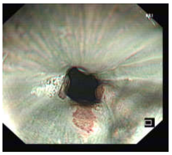 各种各样的胃镜贲门图-老苏