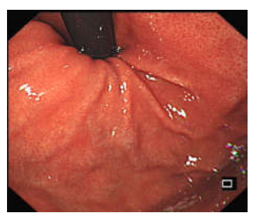各种各样的胃镜贲门图