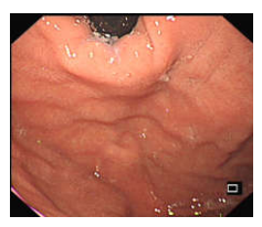 各种各样的胃镜贲门图