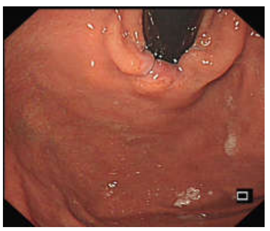 贲门松弛，hill分级-老苏