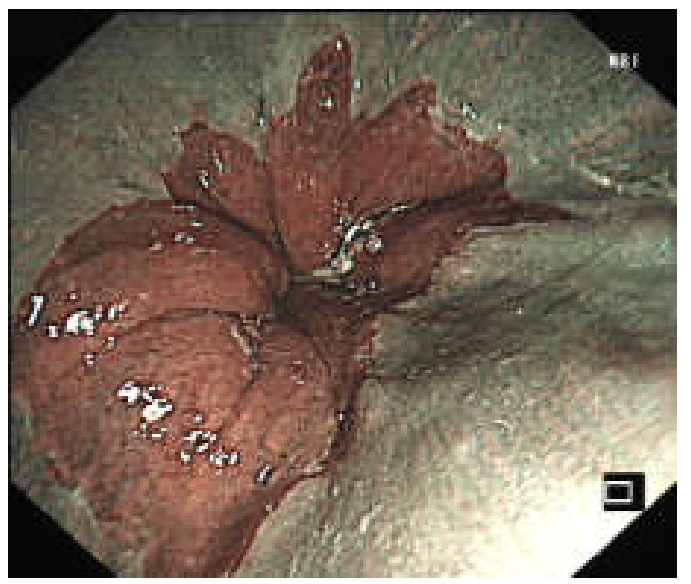 各种各样的胃镜贲门图