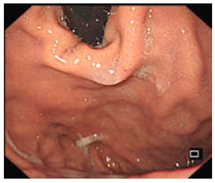各种各样的胃镜贲门图