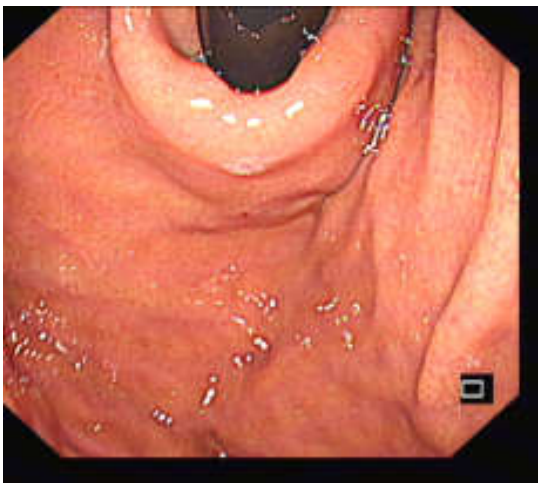 各种各样的胃镜贲门图