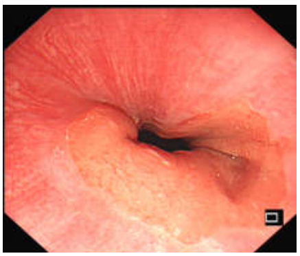 各种各样的胃镜贲门图