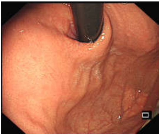 各种各样的胃镜贲门图