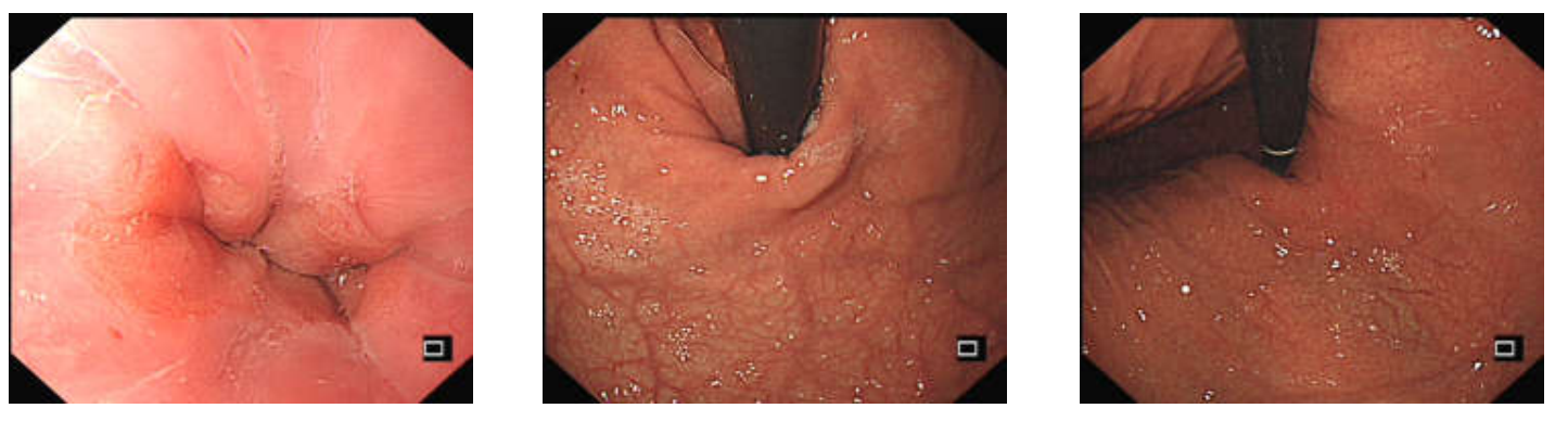各种各样的胃镜贲门图