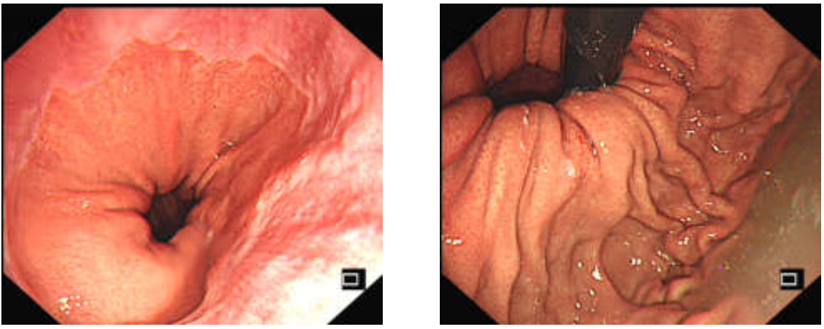 各种各样的胃镜贲门图