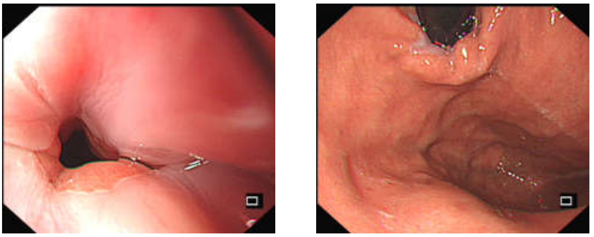 各种各样的胃镜贲门图