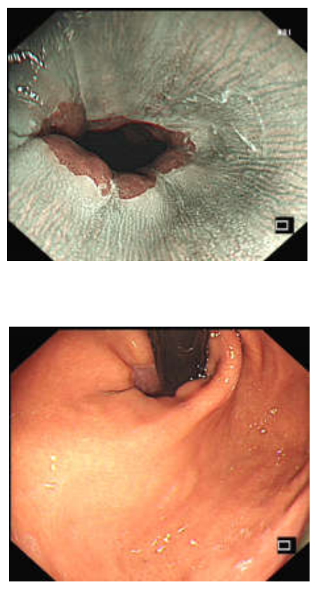 各种各样的胃镜贲门图