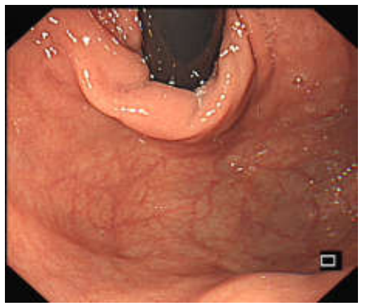 各种各样的胃镜贲门图