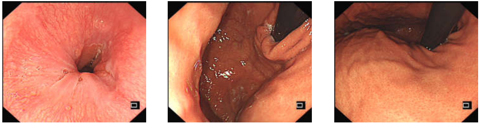 各种各样的胃镜贲门图