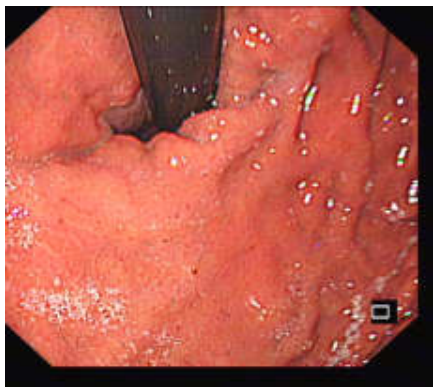 各种各样的胃镜贲门图
