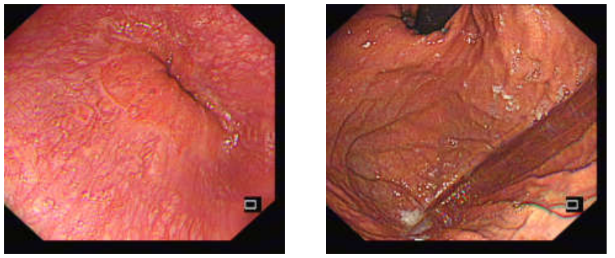 各种各样的胃镜贲门图