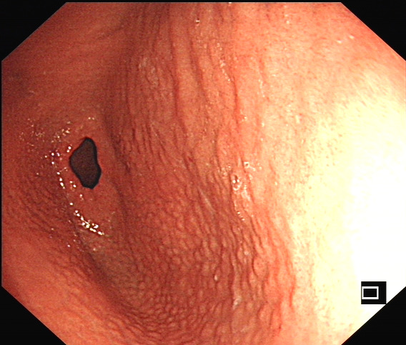 幽门螺旋杆菌感染相关胃炎胃镜下表现-老苏