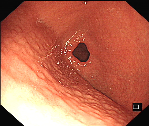 幽门螺旋杆菌感染相关胃炎胃镜下表现