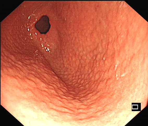 幽门螺旋杆菌感染相关胃炎胃镜下表现