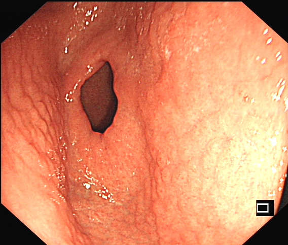 幽门螺旋杆菌感染相关胃炎胃镜下表现