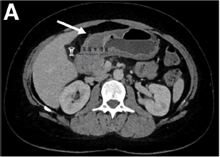 蜂窝织炎性胃炎一例-老苏