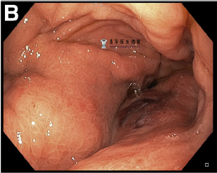 蜂窝织炎性胃炎一例 蜂窝织炎性胃炎一例