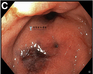 蜂窝织炎性胃炎一例 蜂窝织炎性胃炎一例