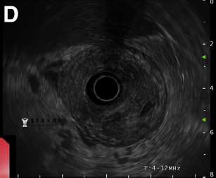 蜂窝织炎性胃炎一例 蜂窝织炎性胃炎一例
