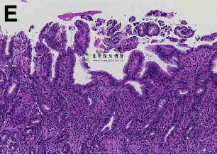 蜂窝织炎性胃炎一例 蜂窝织炎性胃炎一例