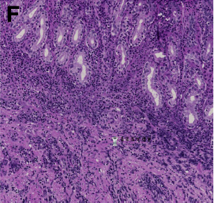 蜂窝织炎性胃炎一例 蜂窝织炎性胃炎一例