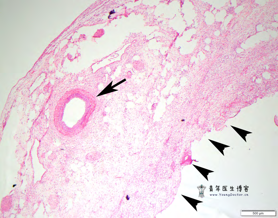 黏膜下恒径动脉破裂出血(Dieulafoy病)-老苏