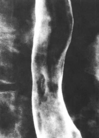 食管疾病的X线造影