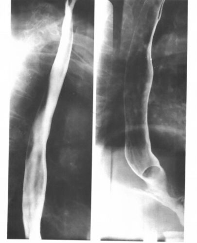食管疾病的X线造影-老苏