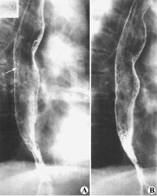 食管疾病的X线造影 食管疾病的X线造影
