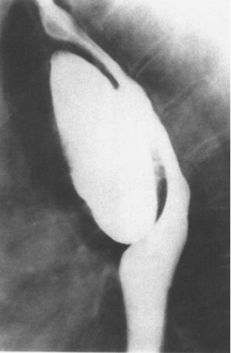 食管疾病的X线造影 食管疾病的X线造影