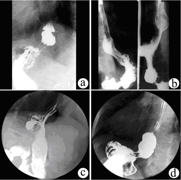 食管疾病的X线造影 食管疾病的X线造影