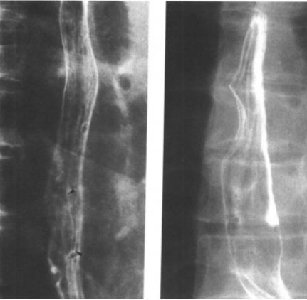 食管疾病的X线造影 食管疾病的X线造影