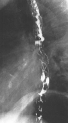 食管疾病的X线造影 食管疾病的X线造影