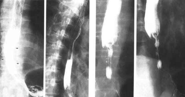 食管疾病的X线造影 食管疾病的X线造影