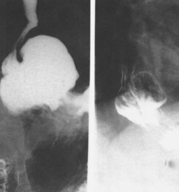 食管疾病的X线造影 食管疾病的X线造影