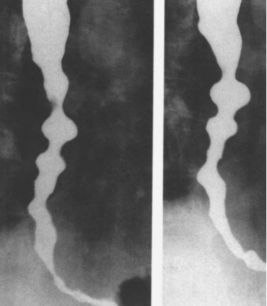 食管疾病的X线造影