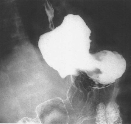 食管疾病的X线造影 食管疾病的X线造影