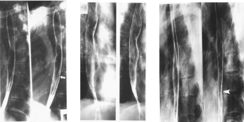 食管疾病的X线造影 食管疾病的X线造影